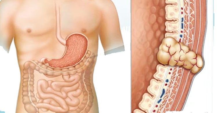 Unusual Sanctuary Site (Central Nervous System) Metastases in Gastrointestinal Stromal Tumor Patients