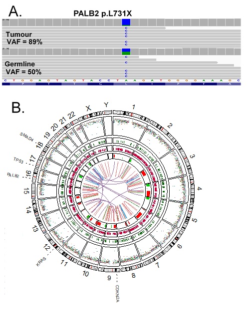 Response to PARP Inhibitor in PALB2-Mutated Metastatic Pancreatic Adenocarcinoma: A Case Report