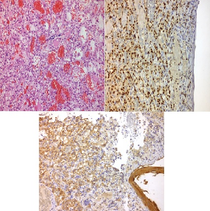 Acrometastases in Renal Cell Carcinoma: A Case Report and Review of Literature