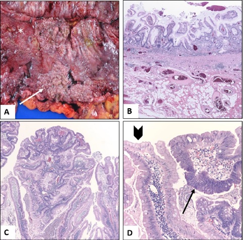 Elective Colectomy in a Patient with Active Ulcerative Colitis and Metastatic Melanoma Enabling Successful Treatment with Immune Checkpoint Inhibitors
