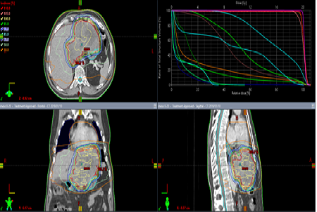 Synergism Between Sequential Immunotherapy and Radiotherapy in A Malignant Pleural Mesothelioma Patient