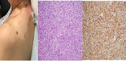 Secondary Cutaneous Myeloid Sarcoma Treated with Nanoliposomal Encapsulation of Daunorubicin and Cytarabine