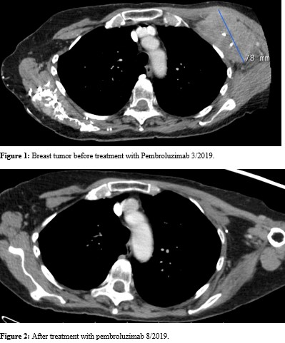 Extreme Response to Immunotherapy in an Estrogen Receptor Positive Breast Cancer: A Case Report