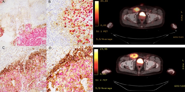Sequential Decitabine and Carboplatin Induced Stabilisation of Tumour Burden in a Patient with Immunotherapy-Resistant Metastatic Melanoma