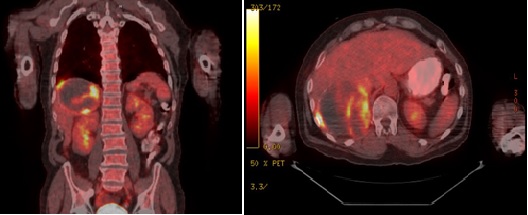 Hepatic Mass Potentially Representing Spontaneous Primary Tumor Involution