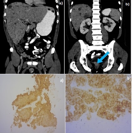 Increased Serum CEA in a Patient with Advanced Small Cell Neuroendocrine Carcinoma