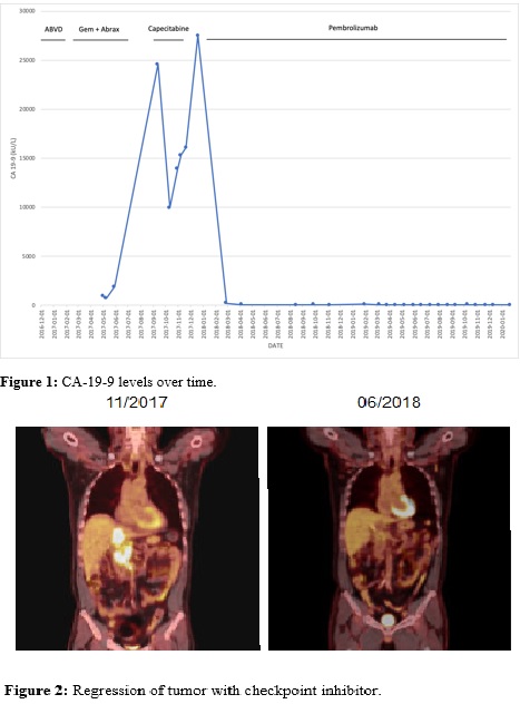 A Complete Response to Immune Checkpoint Therapy in A Treatment Refractory Patient with Metastatic Pancreatic Cancer and Mismatch Repair Deficiency