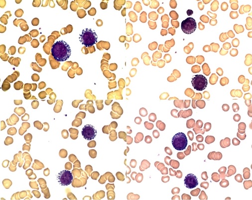 A Case Report of Acute Myeloid Leukemia in a Patient Treated with Pembrolizumab