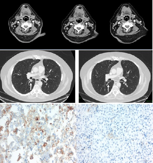 Prolonged Complete Response of Early Stage Primary Adenocarcinoma of The Lung To Nivolumab Monotherapy