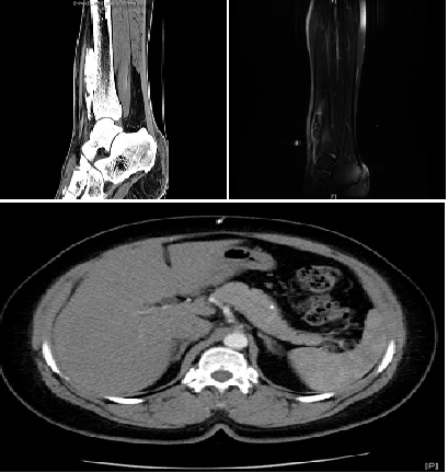Parosteal Osteosarcoma with Pancreatic Metastasis and Multiple Relapses: A Case Report and Comparison with the Literature