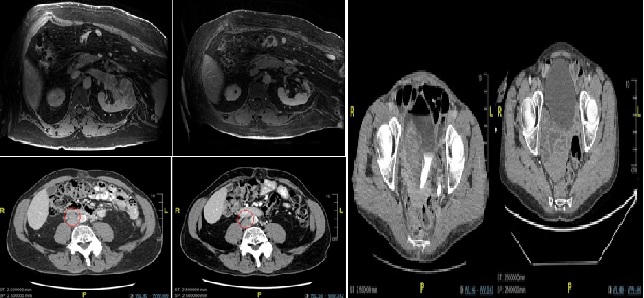 Fenbendazole Enhancing Anti-Tumor Effect: A Case Series