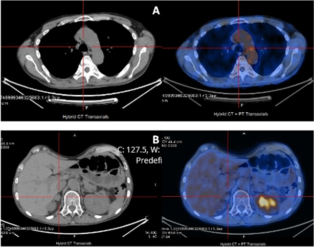 What’s The Odds: Beta-Human Chorionic Gonadotropin in Lung Cancer and Complete Response to Third Line Nivolumab