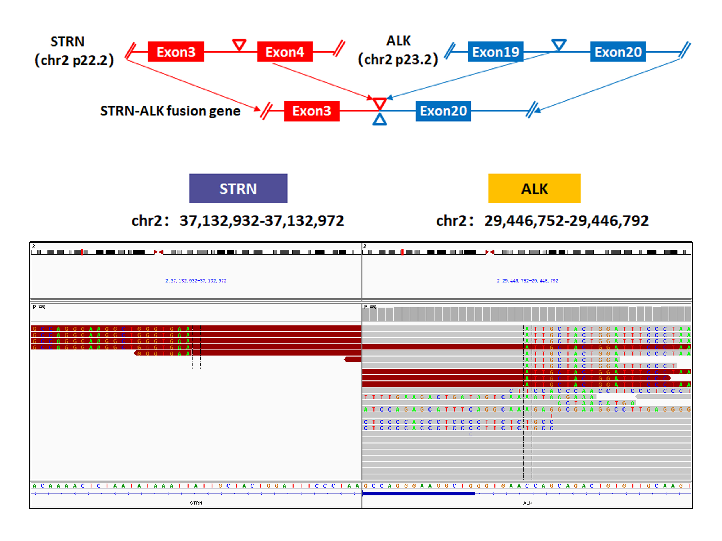 A Case of a Rare STRN-ALK Fusion in Esophagus Adenocarcinoma Exhibits Excellent Response to Crizotinib