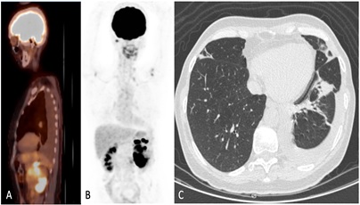 Challenging Radical Nephrectomy after Treatment with Nivolumab