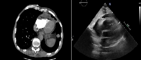 Pembrolizumab Associated Pericardial Effusion In A Patient With Advanced Esophageal Cancer