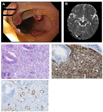 Aggressive Infantile Myofibromatosis with Intestinal Involvement