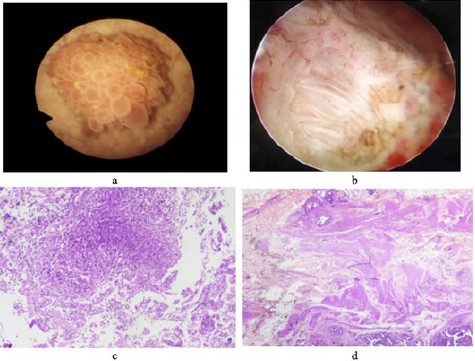 Cisplatin Based Chemotherapy for Non Muscle Invasive Bladder Cancer: Synchronous Gall Bladder Cancer Takes Care of the Other Bladder