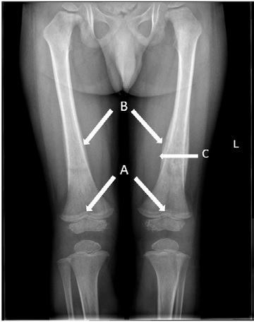 When Bone Lesions Scream For Leukemia-A Paradigmatic Case