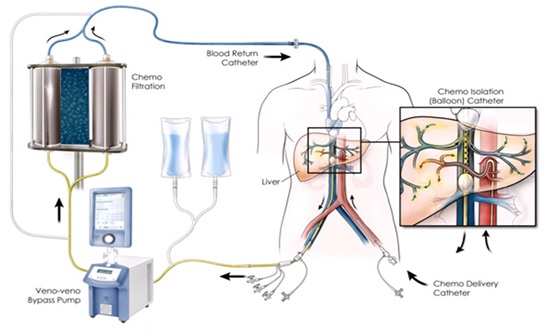 Hepatic Chemoperfusion: A Comparison between Old and New Generation Filters in Patients Affected by Liver Metastasis from Melanoma