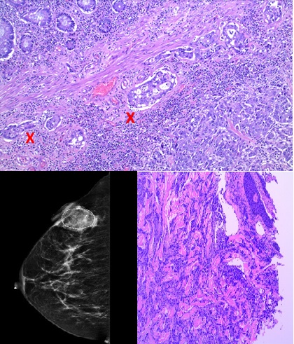 Cecal Cancer Metastatic to Breast