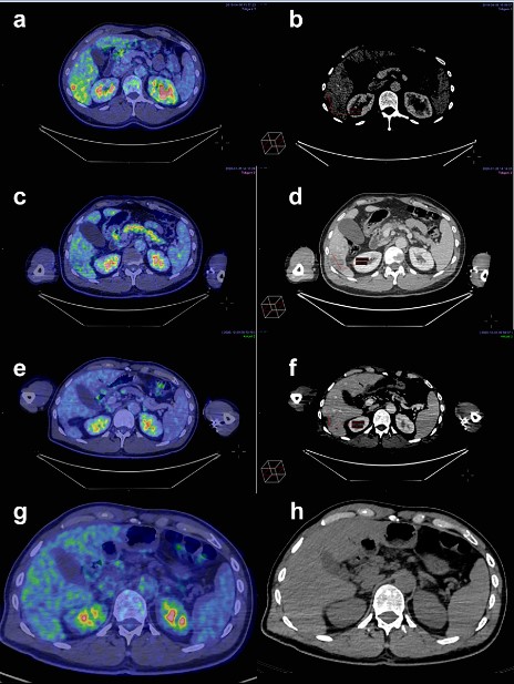 A Case Report of a Patient with Metastatic Uveal Melanoma who Experienced a Complete Response to Treatment with the NIVO3+IPI1 Regimen