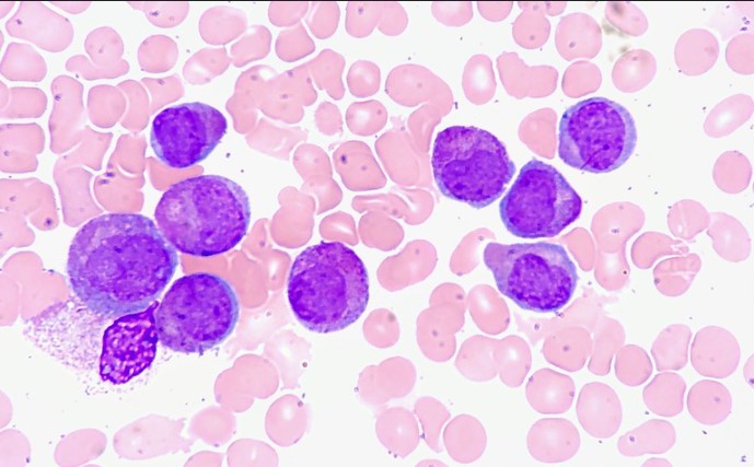 Complete Remission of Acute Myeloid Leukemia in an Elderly Patient with a Single Dose of Venetoclax