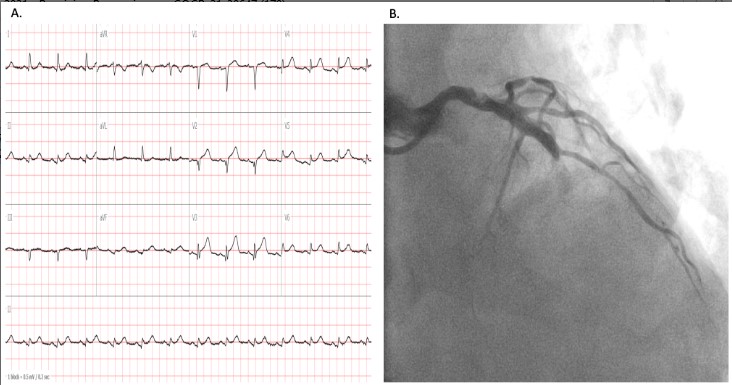 Carboplatin-induced Allergic Coronary Vasospastic Reaction  (Kounis Syndrome)