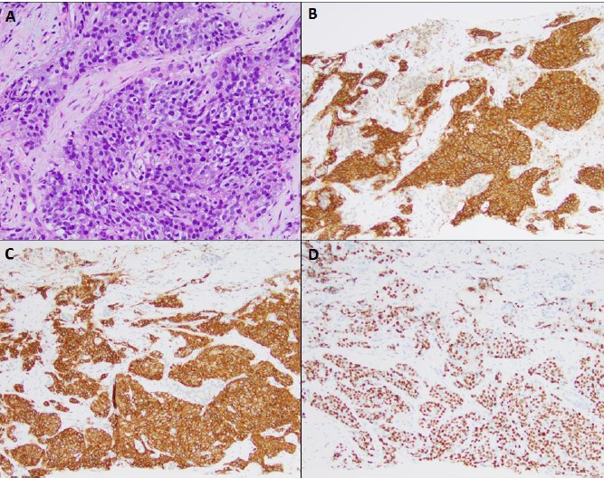 Metastatic Thymic Carcinoma with novel KIT mutations masquerading as a Carcinoma of Unknown Primary Site