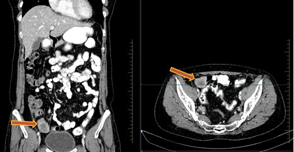 A Rare Ocurrence In Early Stage Endometrial Carcinoma