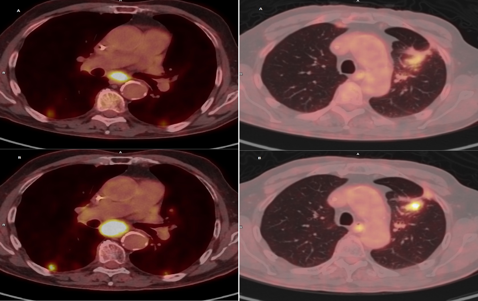 Partial Response to Dual BRAF and MEK Inhibition in a Patient with BRAF-Mutant Pancreatic Acinar Cell Carcinoma Refractory to Chemotherapy: A Case Report and Review of the Literature