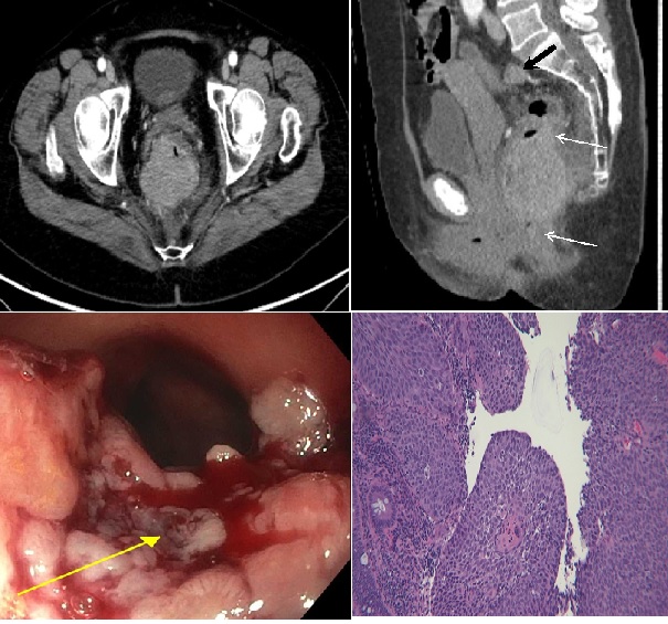 A Rare Case of Squamous Cell Carcinoma of the Rectum Presenting as Hematochezia