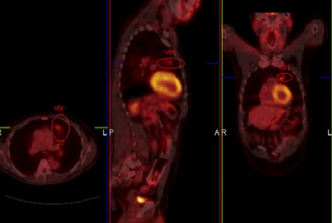 A Rare Form of Synchronous Lung Cancer: Mucoepidermoid Carcinoma