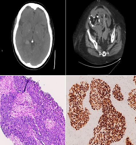 Paraneoplastic Evans Syndrome Associated with Serous Ovarian Carcinoma