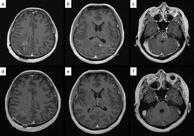 Rare Intracranial Relapse of a Resected Gastrointestinal Stromal Tumour: A Case Report