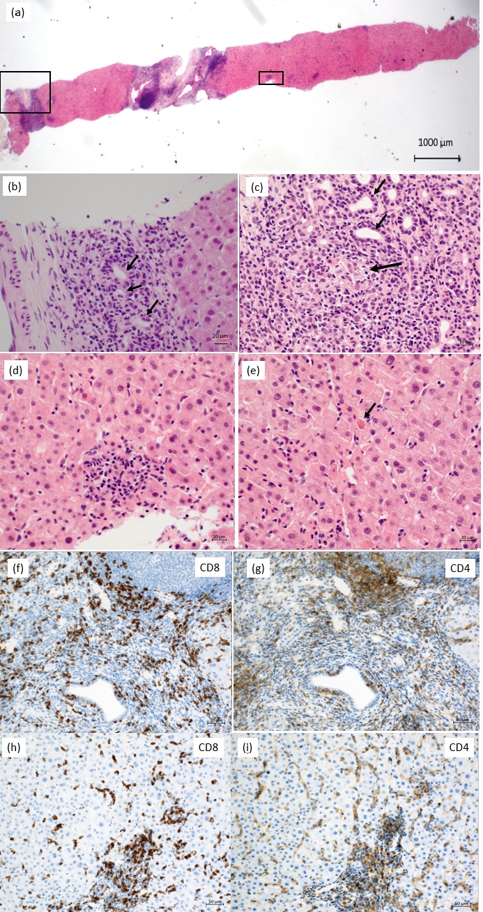 Combination Therapy with Nivolumab and Ipilimumab makes Asymptomatic Primary Biliary Cholangitis Symptomatic: A Case Report