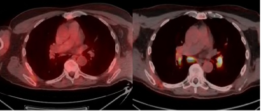 1,25(OH)2D Mediated Hypercalcemia Secondary to Drug Induced Sarcoid Like Reaction From Immune Checkpoint Inhibitors