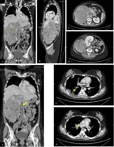 When the Little Dreams Become Huge Nightmares : A Case Report of a Huge Adrenocortical Carcinoma