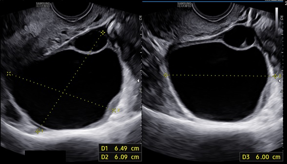 Gynecomastia in Patients with Well-Differentiated Neuroendocrine Tumors Receiving Temozolomide: A Case Series and Narrative Review