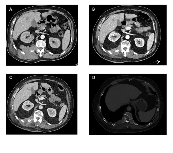 Pazopanib For The Treatment of Malignant Granular Cell Tumors: Case Report and Review of The Literature