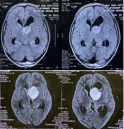 Intracranial Pilocytic Astrocytoma with Spinal Drop Metastasis in an adolescent: A Case Report and Review of Literature