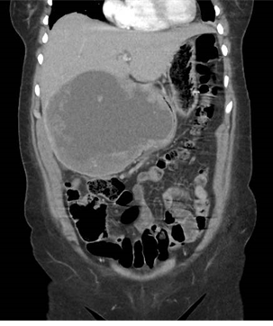 Primary Squamous Cell Carcinoma of the Liver