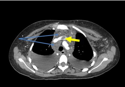 Germ Cell Tumour of the Ovary Presenting with Chylothorax and Central Vein Thrombosis: A case report