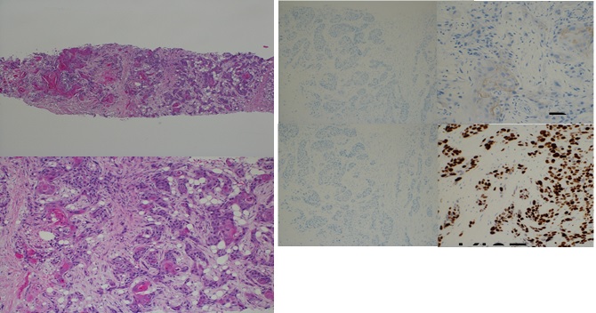 Pure Squamous Cell Carcinoma of Breast which got Long Duration Response and Survival by Sequential Chemotherapy with Combination of Paclitaxel + Bevacizumab, and S-1 Under Limited Treatment Strategy: A Case Report