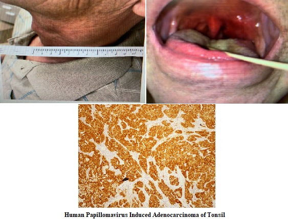 Human Papillomavirus Induced Adenocarcinoma of Tonsil: A Rare Entity
