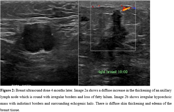 Adenocarcinoma Metastasis to the Breast