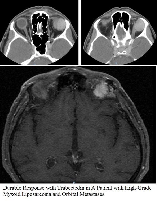 Durable Response with Trabectedin in A Patient with High-Grade Myxoid Liposarcoma and Orbital Metastases