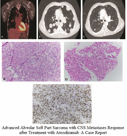 Advanced Alveolar Soft Part Sarcoma with CNS Metastases Response after Treatment with Atezolizumab: A Case Report