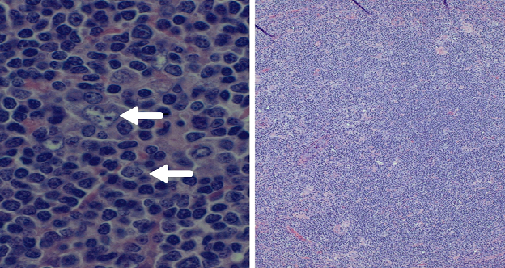 An Unusual Presentation of Nodular Lymphocyte-Predominant Hodgkin Lymphoma While on Antiretroviral Therapy: A Case Report