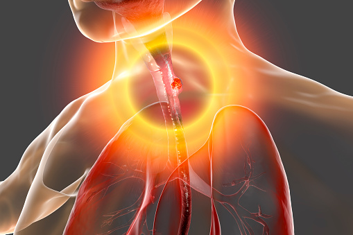 Treatment Care Pathways of Four Patients with Metastatic Gastro-Oesophageal Cancer in the United Kingdom (UK), Utilising Trifluridine/Tiparicil