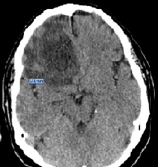 Brain Metastasis of Primary Dedifferentiated Liposarcoma. A Case Report and Review of Literature